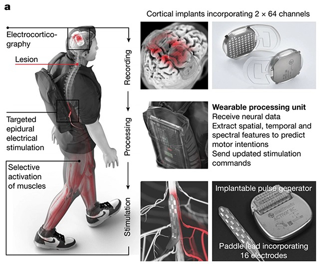瑞士技术让瘫痪男子“站立”两年，马斯克的人脑芯片能否弯道超车？（组图） - 8