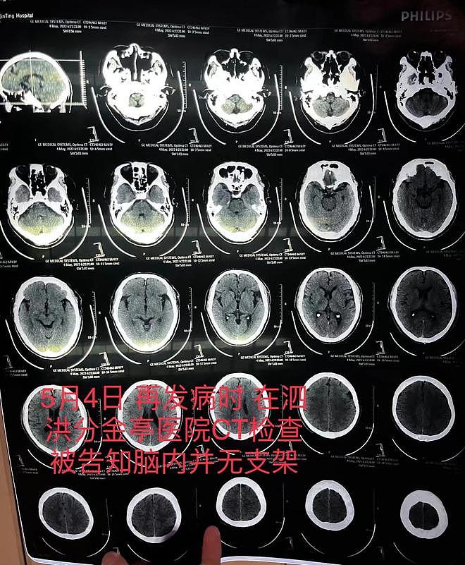 宿迁一患者因脑梗去世，医生承认此前未成功植入脑血管支架并隐瞒（组图） - 3