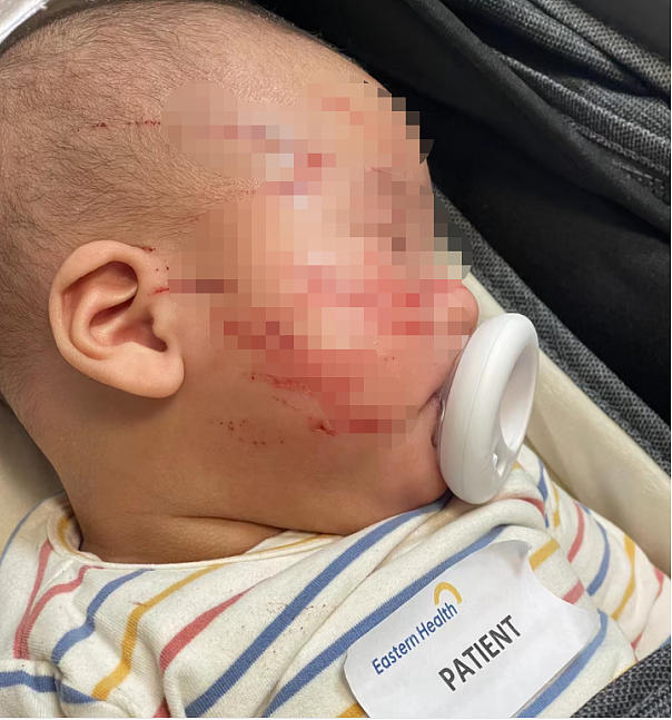 “我儿子在托儿所被攻击了！”墨尔本10周大华人男婴面部遭划伤，满脸血！（组图） - 2