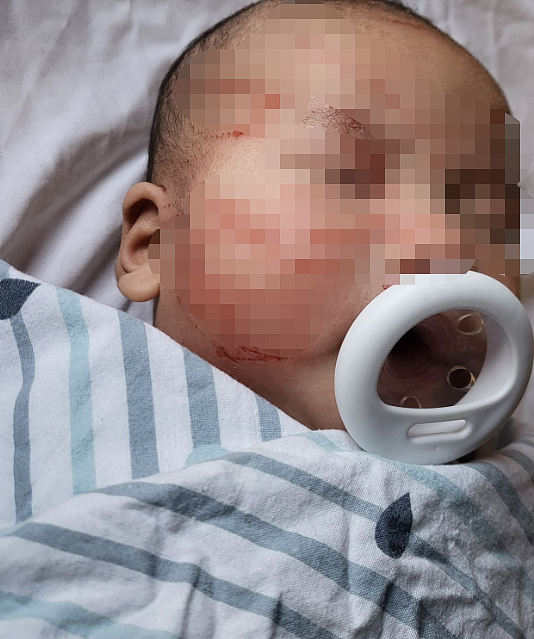 “我儿子在托儿所被攻击了！”墨尔本10周大华人男婴面部遭划伤，满脸血！（组图） - 1