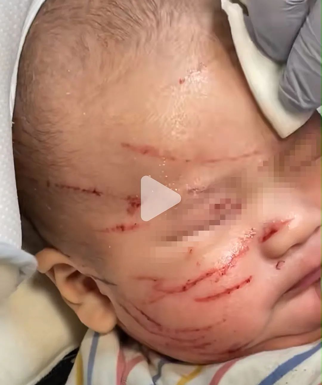 后续！墨10周大婴儿在幼儿园脸被抓烂，当事幼儿园回应，教育部介入调查（组图） - 2