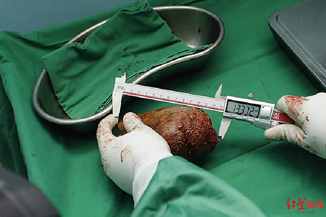 吉尼斯认证！斯里兰卡老兵腹痛开刀，取出801克“世界最大肾结石”（图） - 1