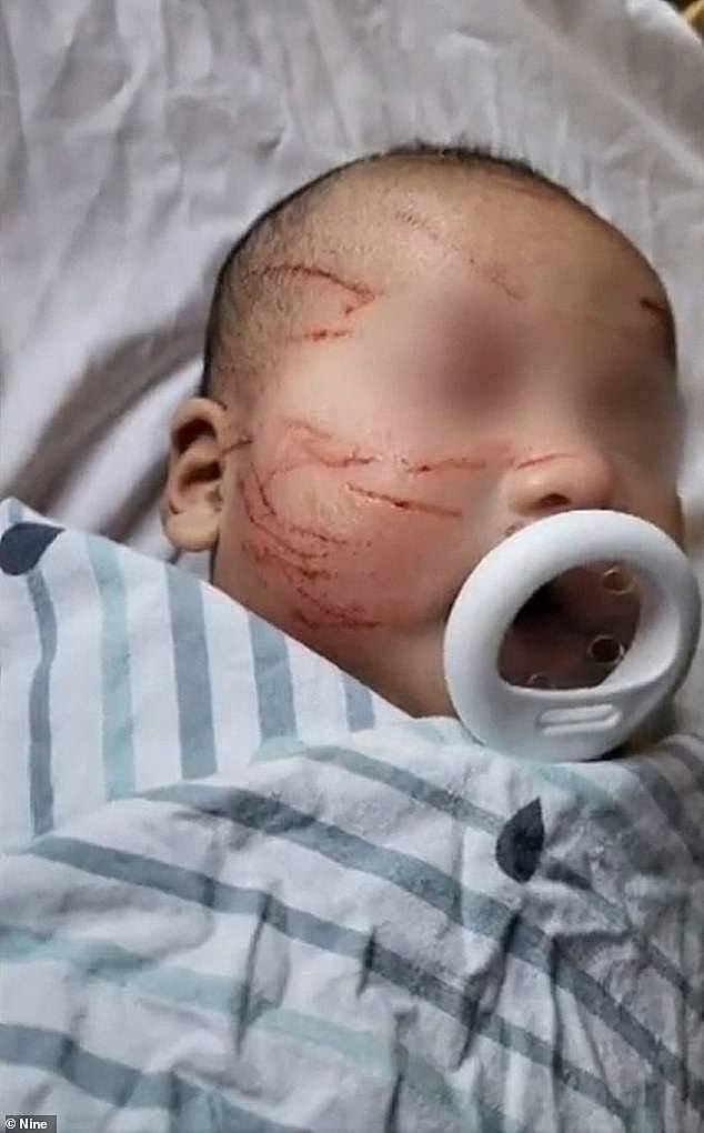 10周宝宝脸全是血红抓痕！墨尔本托婴中心称意外！澳华父母泣诉：这是虐童（组图） - 3