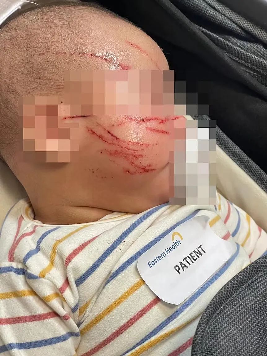 墨尔本10周宝宝被攻击事件续：孩子在托儿所受伤，专家告诉你应该怎样做（组图） - 1