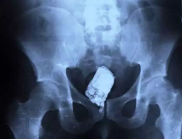 X光下的人体，竟发现有个“炮弹”塞在直肠里...（组图） - 23