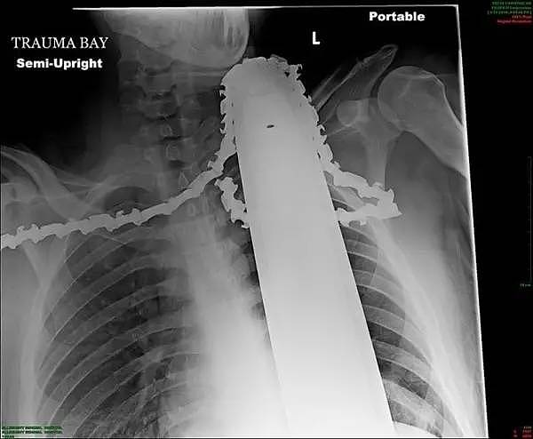 X光下的人体，竟发现有个“炮弹”塞在直肠里...（组图） - 8