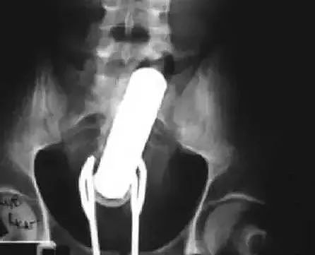 X光下的人体，竟发现有个“炮弹”塞在直肠里...（组图） - 35