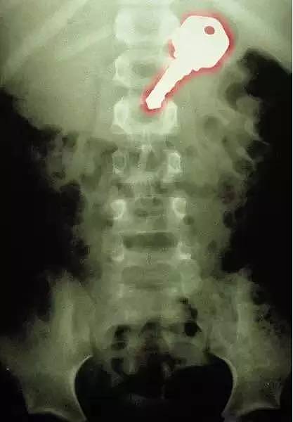 X光下的人体，竟发现有个“炮弹”塞在直肠里...（组图） - 15