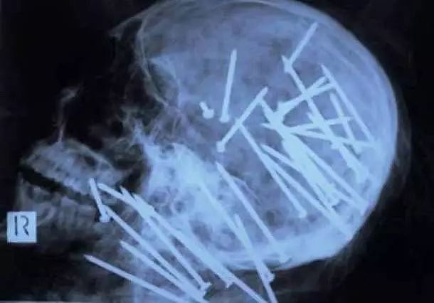 X光下的人体，竟发现有个“炮弹”塞在直肠里...（组图） - 20