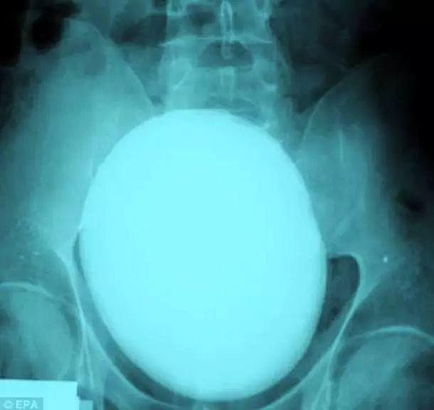 X光下的人体，竟发现有个“炮弹”塞在直肠里...（组图） - 24