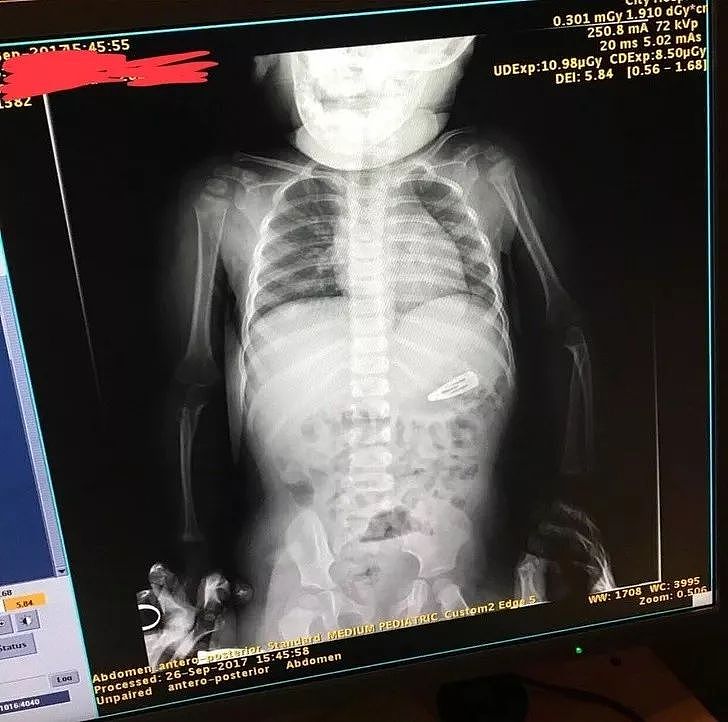 X光下的人体，竟发现有个“炮弹”塞在直肠里...（组图） - 16