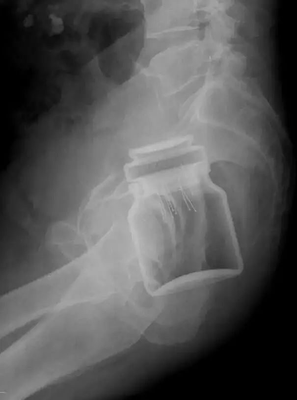 X光下的人体，竟发现有个“炮弹”塞在直肠里...（组图） - 19