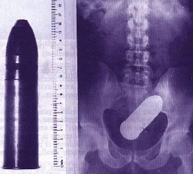 X光下的人体，竟发现有个“炮弹”塞在直肠里...（组图） - 27