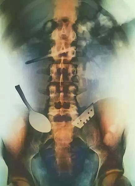 X光下的人体，竟发现有个“炮弹”塞在直肠里...（组图） - 9