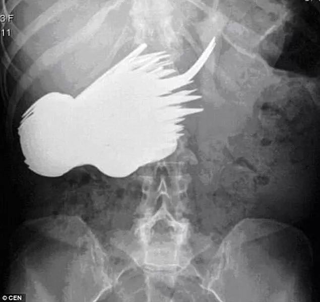 X光下的人体，竟发现有个“炮弹”塞在直肠里...（组图） - 26