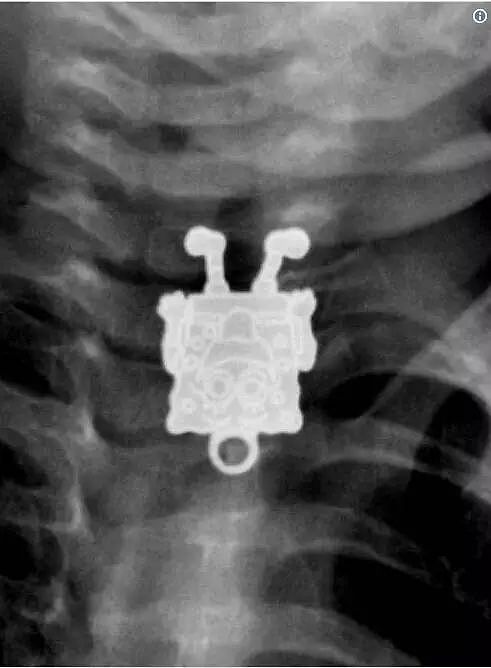 X光下的人体，竟发现有个“炮弹”塞在直肠里...（组图） - 17
