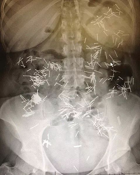 X光下的人体，竟发现有个“炮弹”塞在直肠里...（组图） - 28