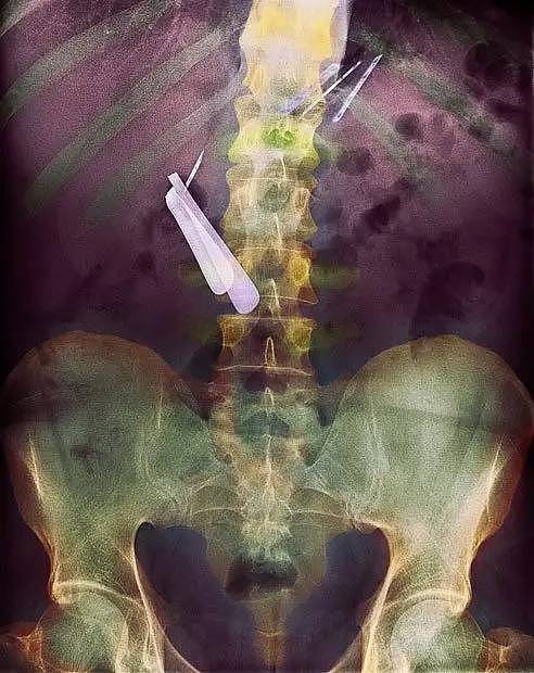 X光下的人体，竟发现有个“炮弹”塞在直肠里...（组图） - 6