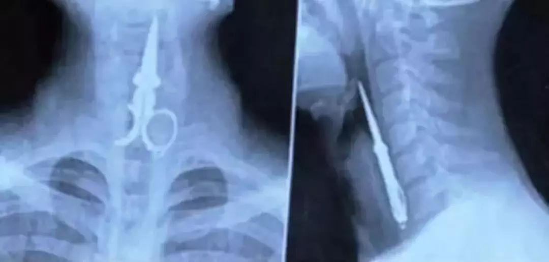 X光下的人体，竟发现有个“炮弹”塞在直肠里...（组图） - 22