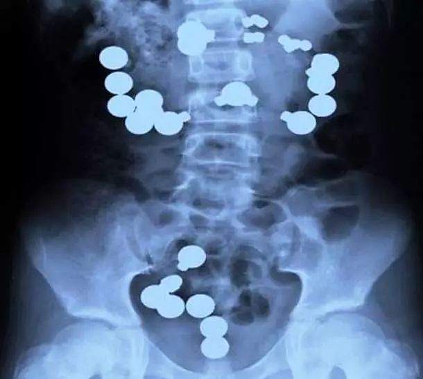 X光下的人体，竟发现有个“炮弹”塞在直肠里...（组图） - 25