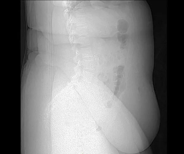 X光下的人体，竟发现有个“炮弹”塞在直肠里...（组图） - 30