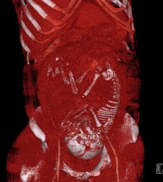 X光下的人体，竟发现有个“炮弹”塞在直肠里...（组图） - 3