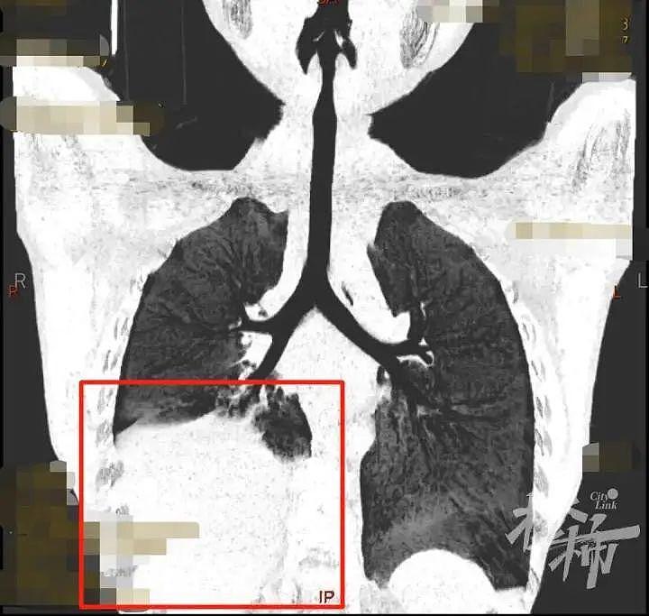 6岁男孩发热11天不退，医生从他的“白”肺中取出一根根“小树枝”（组图） - 1