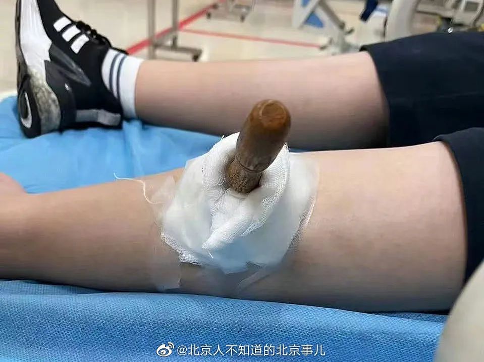 上海11岁小学生被同学用劳技课铁锥刺穿小腿，肇事者父母的隐身让人后怕…（组图） - 1