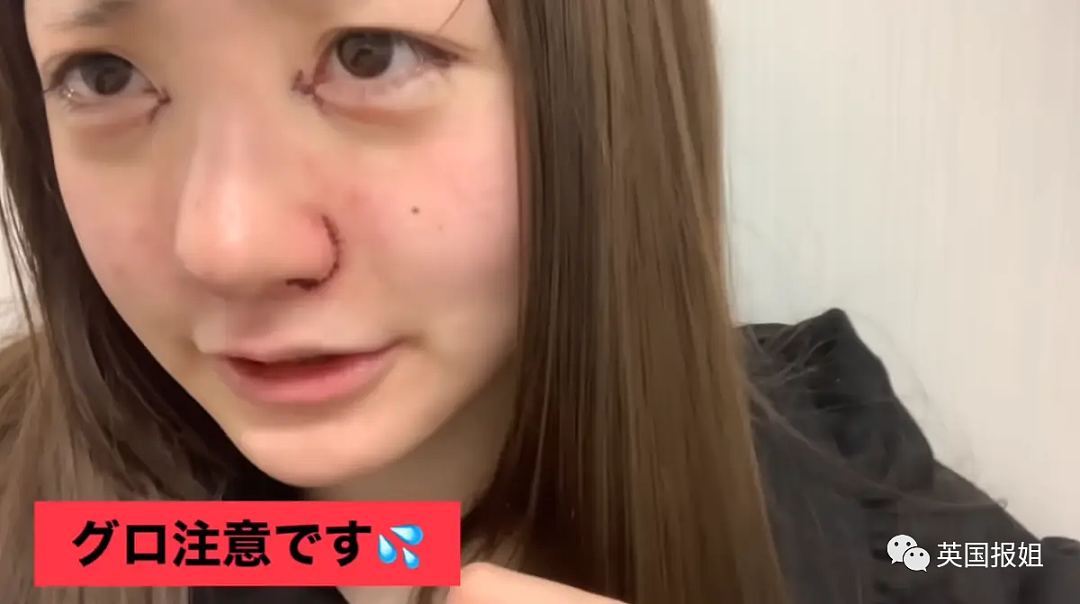 15岁日本美少女网红整容失败，对比照震惊网友！母亲竟纵容她花900万“换头”（组图） - 17
