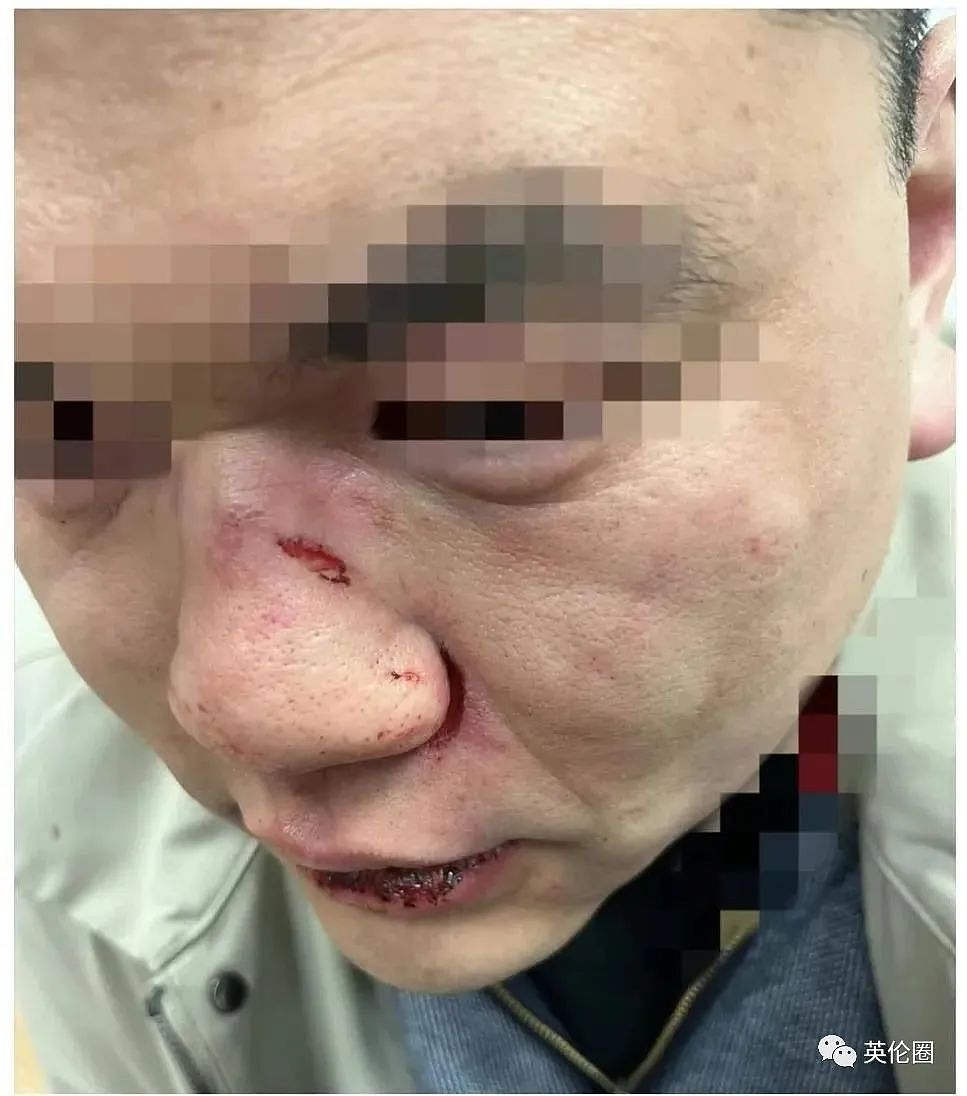 中国女留学生自曝遭种歧殴打，当街被摁住手脚掐脖子，险些窒息！“路人冷眼旁观”（组图） - 16