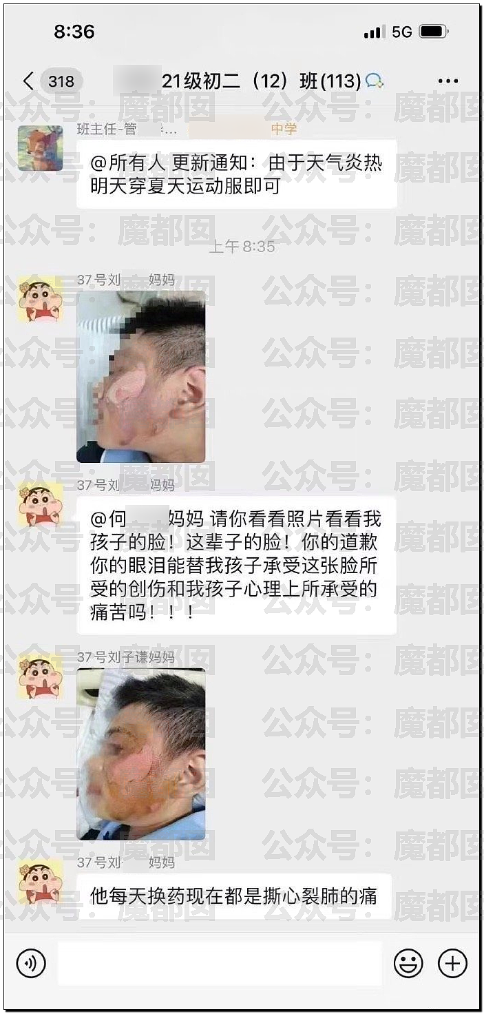 震惊！中国高校女生蓄意泼男生腐蚀性液体导致烧伤，引发全网震怒（视频/组图） - 2