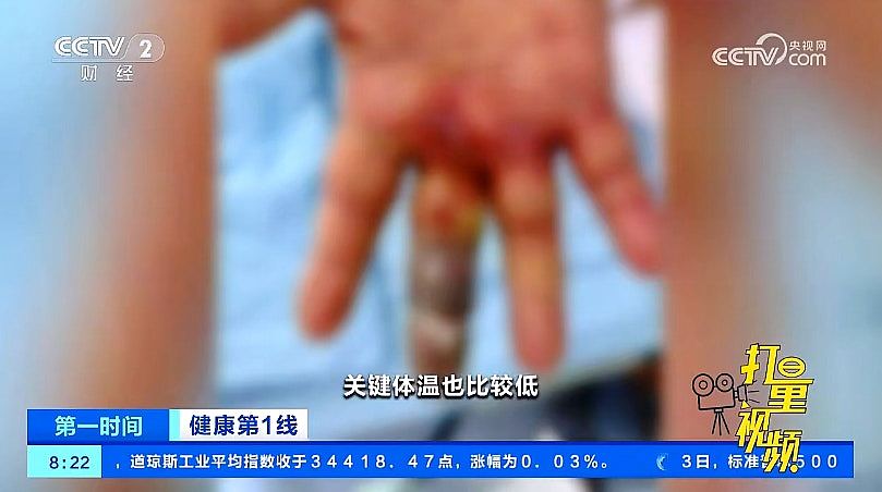 深圳男被罗非鱼骨刺伤惨截中指！医生：感染创伤弧菌严重可致死（组图） - 2