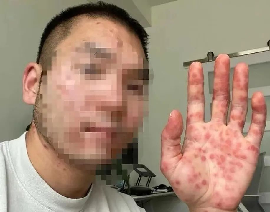 6月中国新增106例猴痘感染者，猴痘疫情为何突然暴发？（组图） - 13
