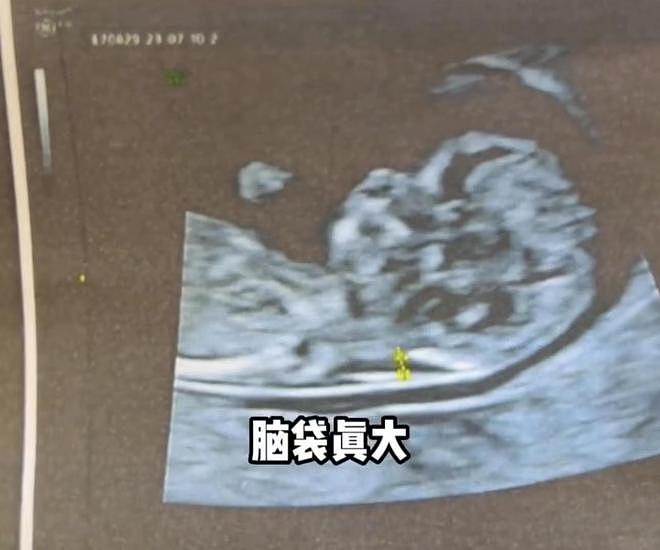 赵本山女儿已怀孕3月！晒宝宝B超照显兴奋，曝孕反严重呕吐浑身疼（组图） - 5
