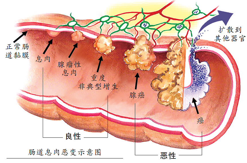 男子肠道长200多个息肉：体检发现肠息肉要切除吗（组图） - 4