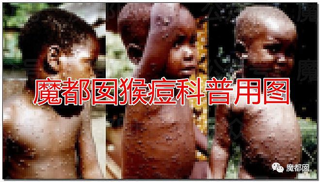 震撼！糜乱的代价是生命，中国海关总署公告152例猴痘死亡！（组图） - 17