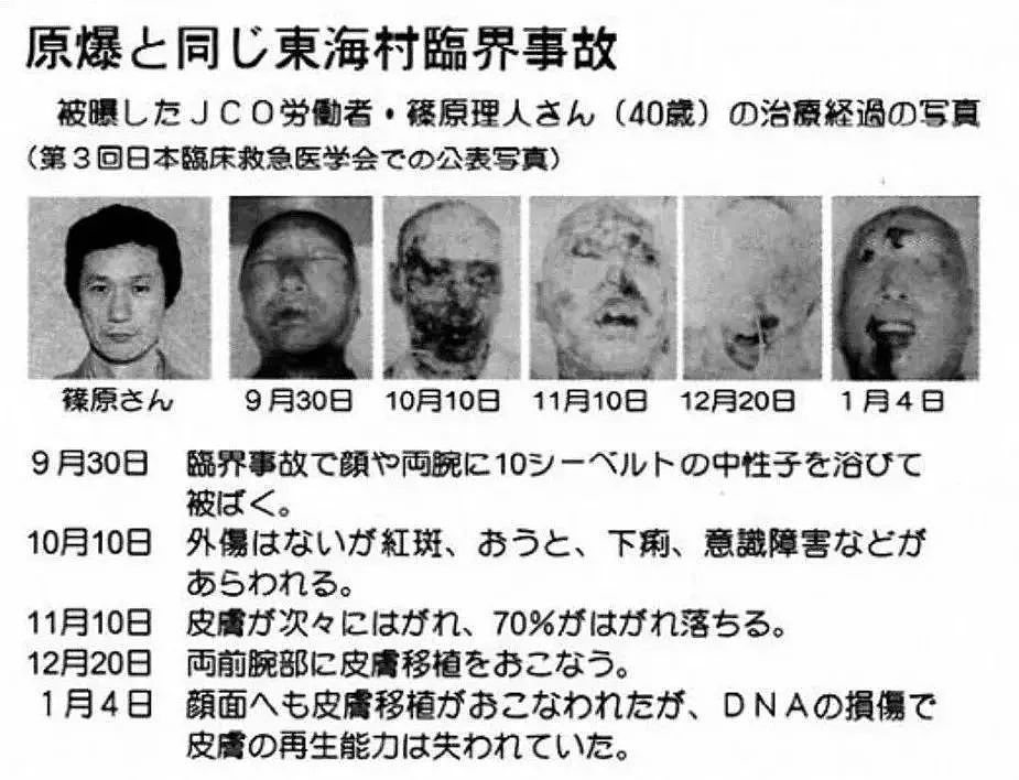 慎入！日本男子遭核辐射，被强行续命83天，亲眼看着自己融化而死（组图） - 21