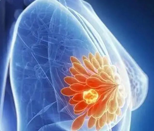 姚贝娜查出乳腺癌时是早期，经过化疗后已痊愈，为何人还是没了（组图） - 2