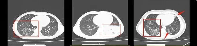 检测阳性，浙江11岁女孩查出“白肺”！病例有明显增加，家长千万别这样做......（组图） - 2