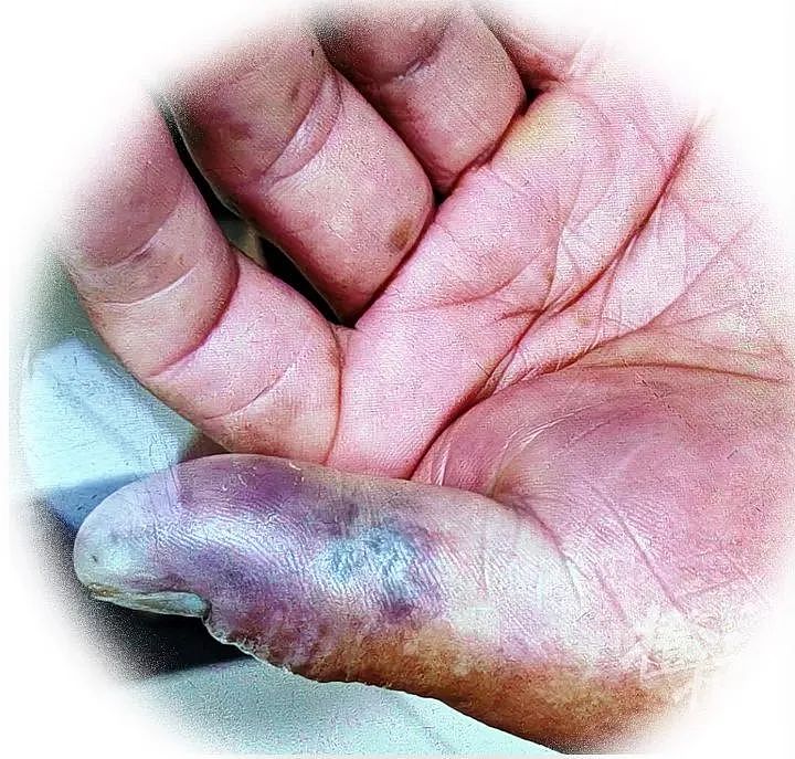 洗小龙虾时大拇指被扎，男子多脏器衰竭不幸离世！一个小伤口，为何会致命？（组图） - 1