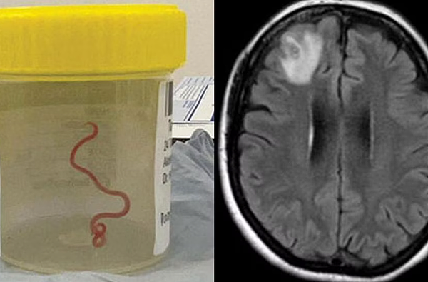 医生从澳女大脑取出8cm活虫！只出现在“蟒蛇体内”，成世界首例（组图） - 2