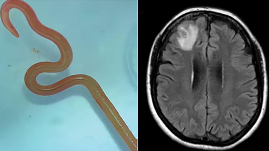 医生从澳女大脑取出8cm活虫！只出现在“蟒蛇体内”，成世界首例（组图） - 3