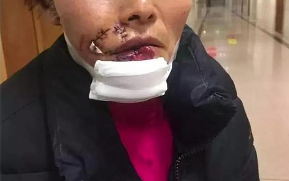 女子被狗撕碎左脸，缝了500多针！警方已介入调查（图） - 1