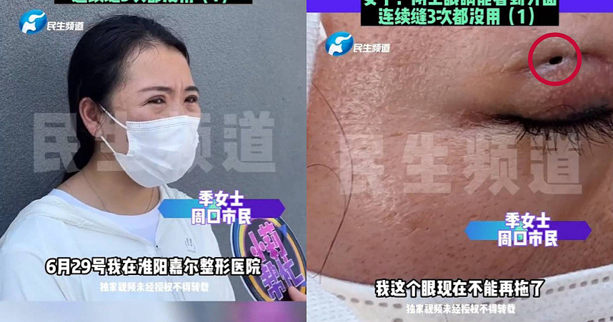 中国女子修复双眼皮，术后成果闭眼还能看到外面（图） - 1