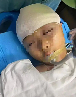 湖南一小学家长称孩子被教师打碎头骨，开颅手术花5个小时，学校回应（组图） - 1
