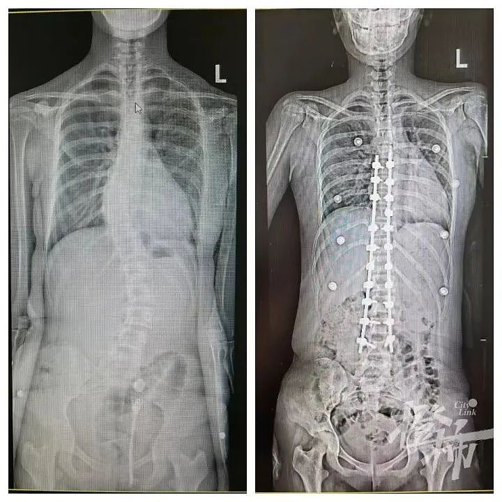13岁女孩身高超过1米7，父母以为她长得快没在意，没想竟是“天才病”，只能手术（组图） - 2