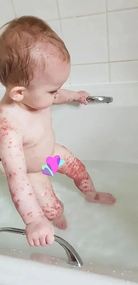1岁女婴突然浑身长紫色疹子，急诊4天才脱险！妈妈一查原因竟然是（组图） - 1
