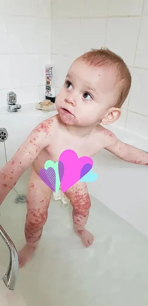 1岁女婴突然浑身长紫色疹子，急诊4天才脱险！妈妈一查原因竟然是（组图） - 2