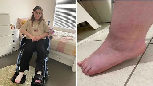 穿衣服都疼！澳洲小女孩不小心扭伤脚，从此患上罕见病，全身剧痛3年……（组图） - 2
