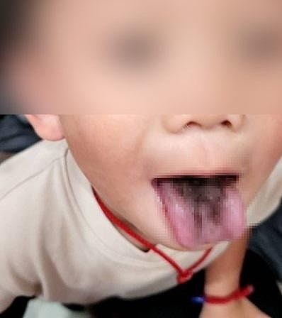 4岁男童舌头长黑毛！不痛无异味，或与长期使用抗生素有关（组图） - 2